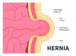 What Can Cause a Hernia? Diet, Age, and Genetics Explained What Can Cause a Hernia? Diet, Age, and Genetics Explained
