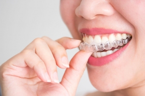 Invisalign Aligners Invisalign Aligners